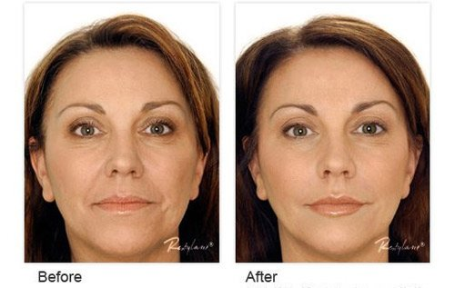 Restylane Dermal Fillers – The Dynamic Duo of Facial Rejuvenation