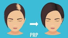 What Is Platelet-Rich Plasma Therapy, and Can PRP Help Treat Hair Loss?
